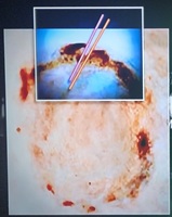 Dental impression of suspect in murder case