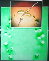 Dental impression of suspect in murder case